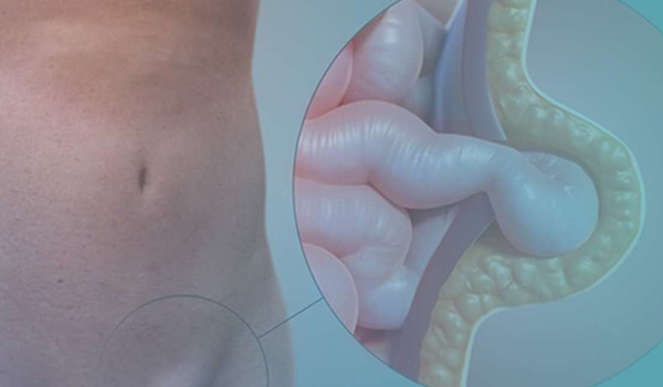 CIRUGÍA DE LA HERNIA ABDOMINAL